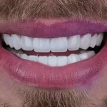 مراقبت های بعد از ونیر کامپوزیت دندان